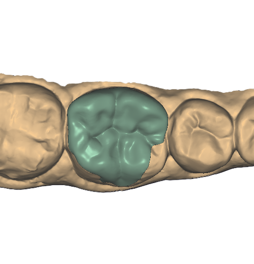 Partial Onlay Model 2